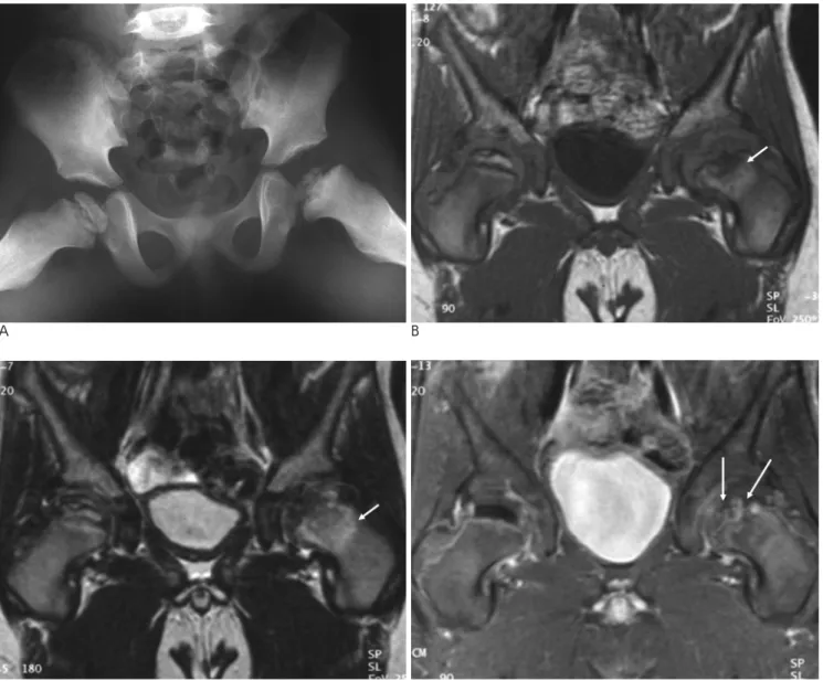 Fig. 4. Bilateral LCP disease in a 6-year-old boy  