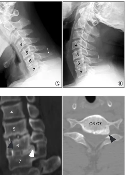Figure  1.  Lateral  radiographs  taken  in  flexion (A) and extension (B) at 14 months  after the initial operation are shown