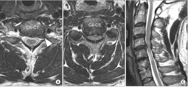 Figure 3. T2-weighted magnetic resonance images show a large foraminal spur (white arrowhead) from the left uncinate process of C7 (A), spinal  cord compression between the herniated disc and slightly buckled ligamentum flavum at C4-5 (B, C), and cord sign