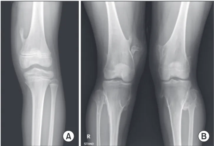Figure 1. (A) A pedunculated osteochondroma in the distal femur. (B)  Antero-posterior radiograph of the knees in a woman with multiple  hereditary osteochondromas.