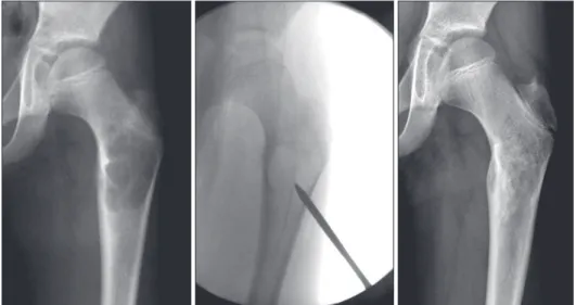 Figure 12. An osteoid osteoma in the diaphysis of the tibia showing the  extensive periosteal reaction and central radiolucency.