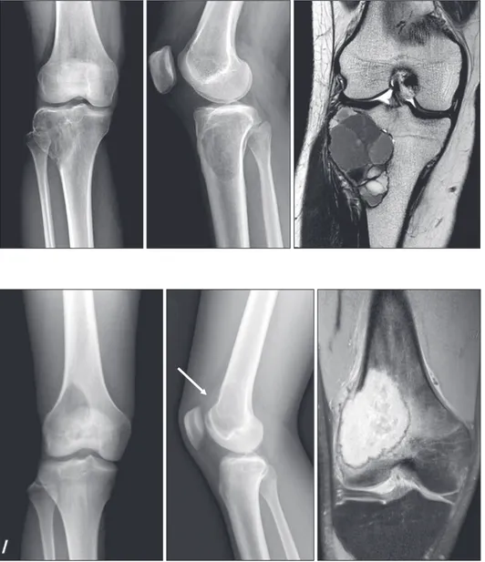 Figure 17. A giant cell tumor in the prox- prox-imal tibia of a 28-year-old woman.