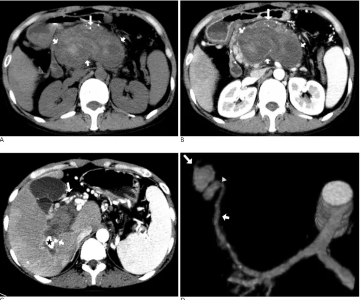 Fig. 1. A. The unenhanced axial CT scan reveals the intraductal stones (long arrow) in the pancreatic body and a high density thrombosis at the portal?splenic vein (short arrows).