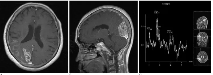 Fig. 2.  Subacute infarction in a 56-year-old man presented with left side hemiparesis