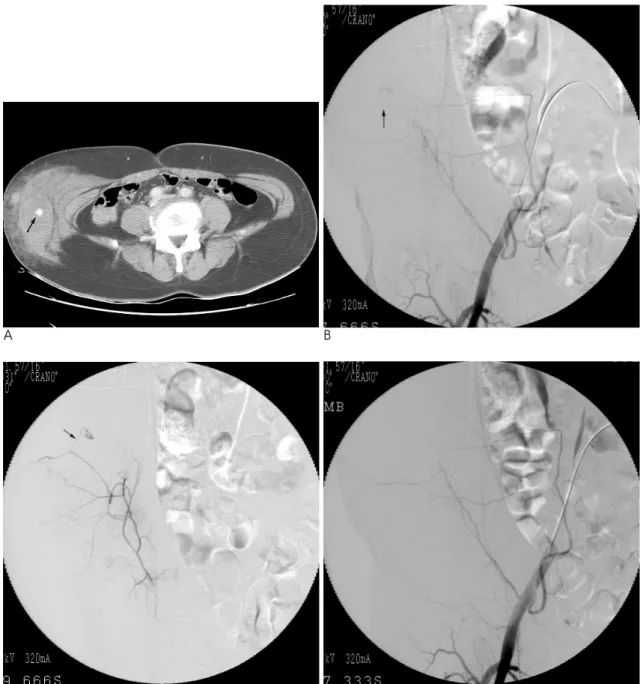Fig. 1. NBCA embolization performed for abdominal wall bleeding (Patient No. 2).