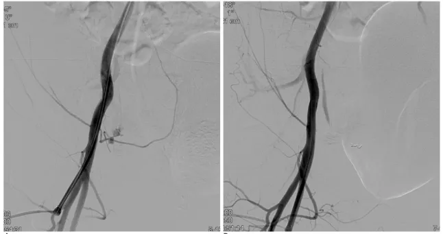 Fig. 2. NBCA embolization performed in combination with a coil (Patient No. 6).