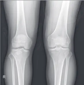 Figure 1. Plain radiograph showed asymmetric joint space narrowing  (lateral side) of the left knee