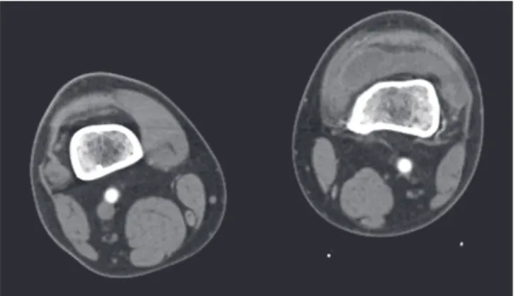 Figure 5. (A) Active bleeding and hyper- hyper-vascularity  (arrow)  were  seen  in   inter-vention radiography