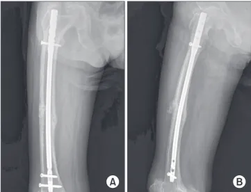 Figure 3. (A, B) Using contralateral curved intramedullary nailing, the  operation was performed