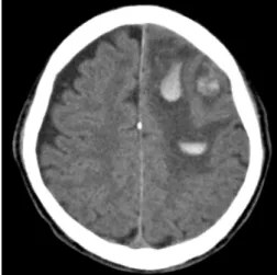 Fig. 1. The initial non-enhanced CT at the time of injury shows multifocal hemorrhages in the left frontal lobe.