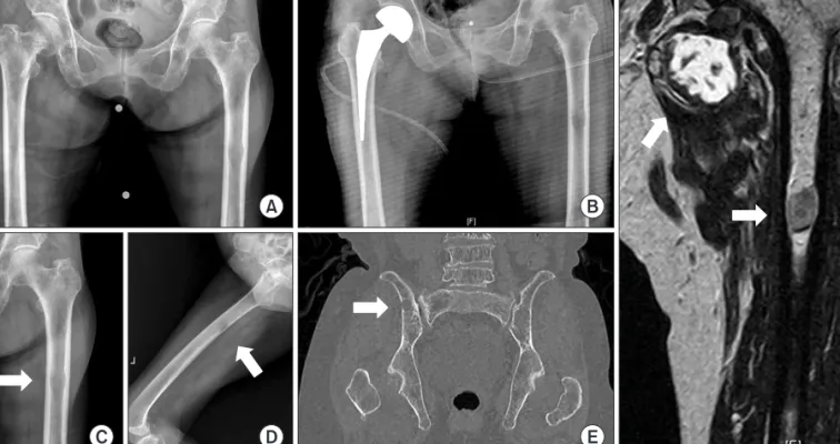 Figure 2. On the plain radiographs of the (A) antero­posterior view and (B) axial view of the shoulder, osteopenia was seen in the humeral head with  diffuse swelling of the deltoid area