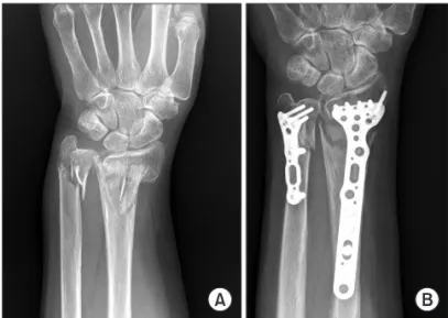 Figure 1. Classification of distal ulnar fracture proposed. Cited from the  article of Biyani et al