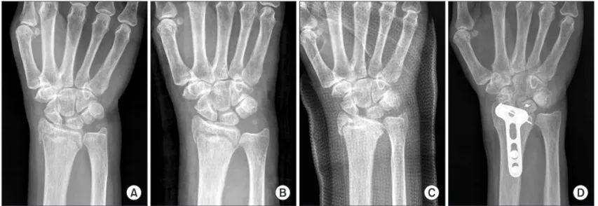 Figure 1. Scapho­lunate interosseous ligament injury associated with a distal radius fracture