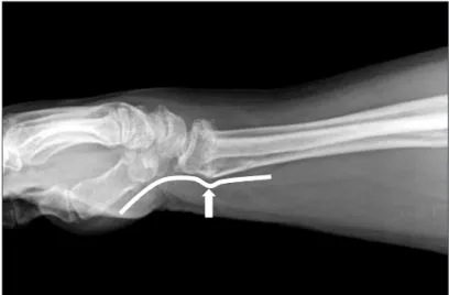 Figure 3. Delayed carpal tunnel syndrome can be caused by malunited  distal radius fracture (arrow).