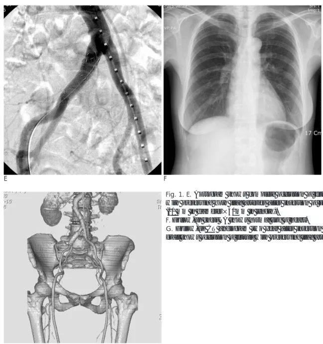Fig. 1. E. Aortogram shows complete occlusion of fistula tract with preserving both iliac arteries after insertion of stent-graft (10 mm in diameter×30mm in length).