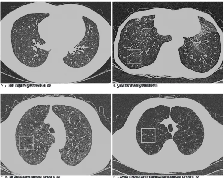 Fig. 1. Thin-section CT scans of the chest (window level, -850 HU; width, 400 HU). On each image, rectangular (64×64 pixel) highlight regions of interest (ROI) that is typical of a particular condition