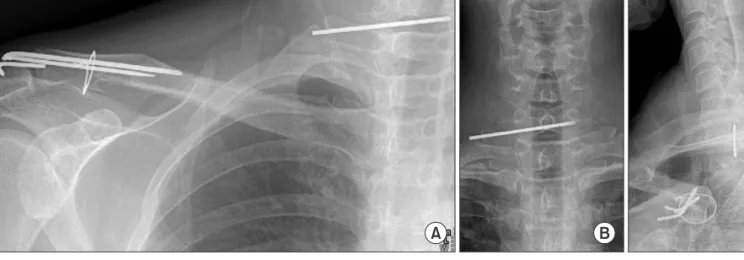 Figure 2. Coronal (A) and axial (B, C) cervical computed tomography scans confirming migration of the K-wire into the cervical spinal canal at the C7  level