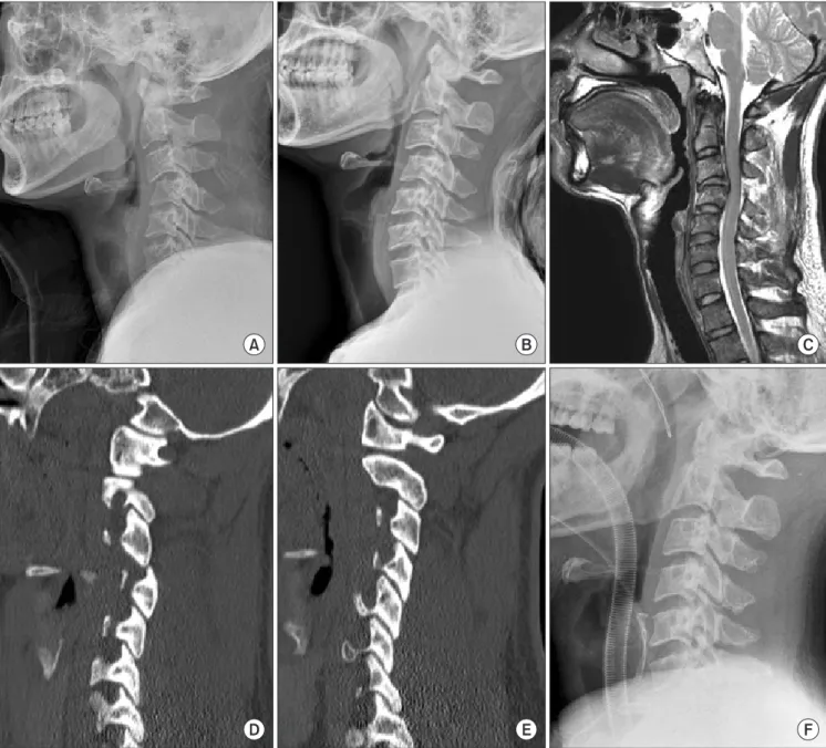 Figure 1. (A) This radiograph shows a unilateral facet dislocation in a 30-year-old male at C3-4 level, (B) shows that closed reduction failed by  Gardner-Well tongs traction