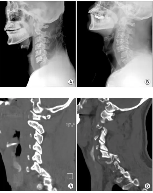 Figure 2. (A) Lateral view radiograph of a  31-year-old male. Listhesis of C6 on C7  with dislocation of the left unilateral facet  joint