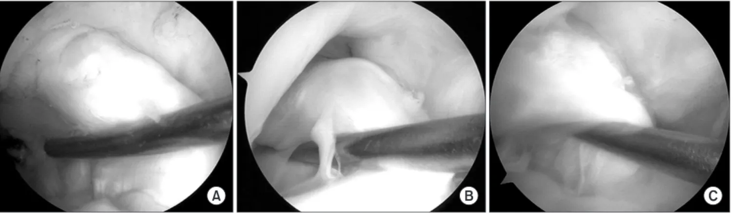 Figure 3. Arthroscopic classification of grafts based on synovialization. (A) Good synovialization of the grafted tendon