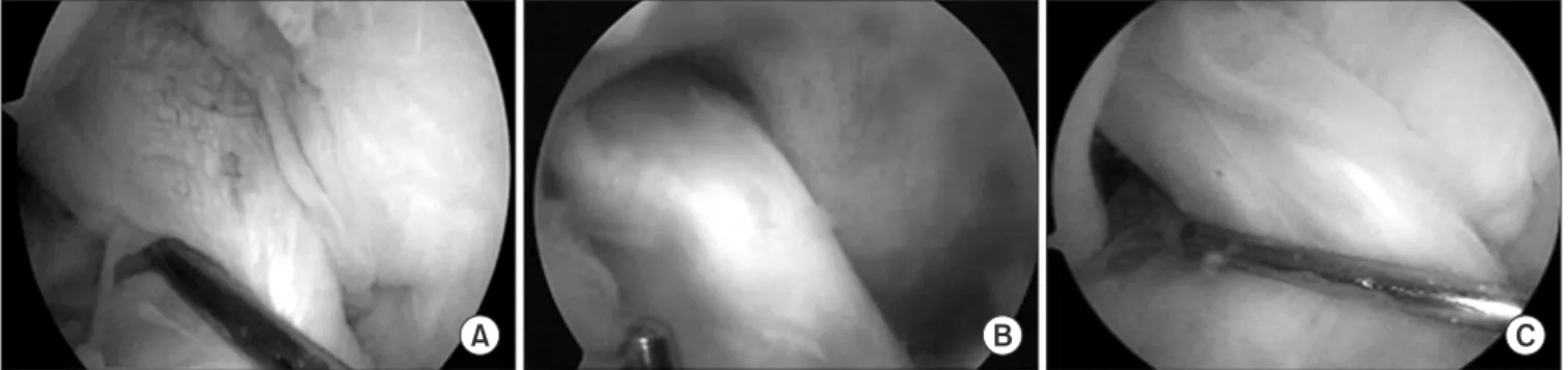 Figure 1. Measurement of graft tension at second arthroscopic finding. (A) Less than 3 mm graft tension was observed