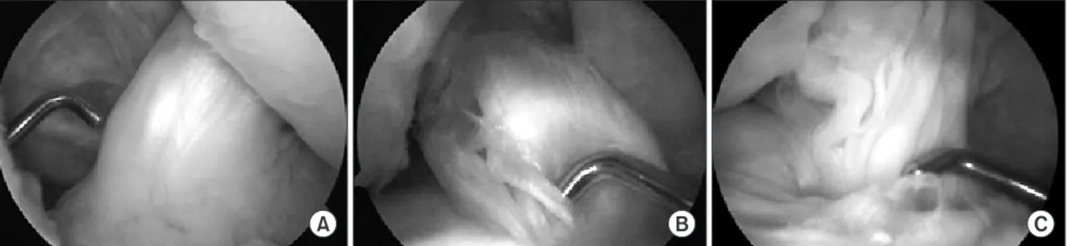 Figure 3. Measurement of graft synovialization at second look arthroscopic finding. (A) Good synovialization was seen