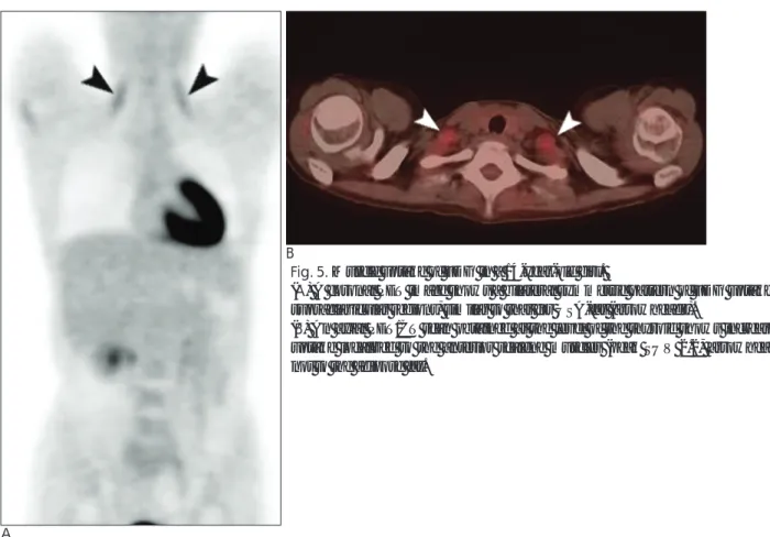 Fig. 4. Normal FDG uptake in the thymus of a 16-year-old boy.