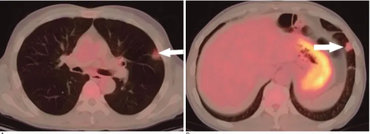 Fig. 15. Eosinophilic pneumonia in an asymptomatic 55-year-old man with peripheral eosinophilia