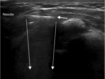 Figure 2. Ultrasonography shows the reverberation by the needle  (arrow). Dotted arrows indicate the comet-tail artifact behind the needle.