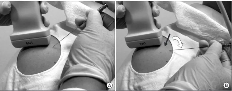 Figure 5. Incidence angle of the needle can be increased by change of the puncture site apart from the transducer: (A) near the transducer, (B) apart  from the transducer