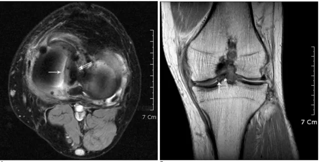 Fig. 3. 36-year-old man with Bucket-handle tear in medial meniscus, which was interpreted as Bucket-handle tear on axial MR im- im-age.