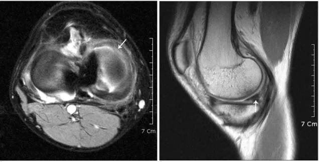 Fig. 6. 19-year-old man with horizontal and longitudinal tears in medial meniscus.