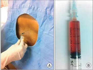 Figure 4. (A) Lumbar 4-5 level puncture. (B) Hematoma mixed with  cerebrospinal fluid was aspirated by 3 ml.
