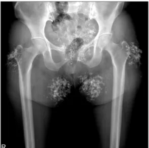 Figure 1. Plain radiograph of hip joint. Preoperative plain radiograph  of hip joint is showing huge multinodular calcified mass in both hip,  sacrum, buttock.