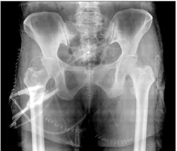 Figure 4. Plain radiograph of hip joint after 2nd excision and biopsy. 
