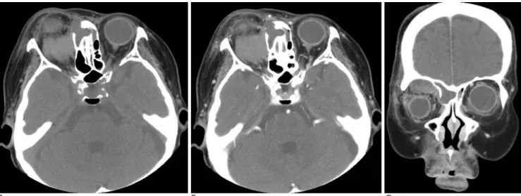 Fig. 2. Microscopically, the mass is composed of blood clots (H
