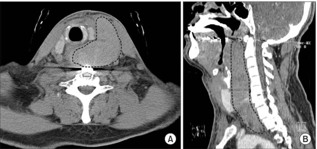 Figure 3. (A) Computed tomography axial  scan shows a massive hematoma at the  C7  area,  which  pushes  the  trachea  to  the  right