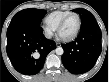 Fig. 1. A chest CT scan reveals a pulmonary artery aneurysm has increased in size measuring 2.5 cm in the maximum  diam-eter on the right lower lobe.