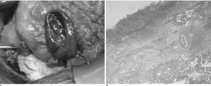 Fig. 2. A. Intraoperative photograph shows cyst within the C-loop of the duodenum. 