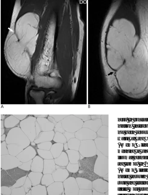 Fig. 3. A 54-year-old man with an in- in-tramuscular lipoma.