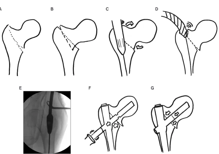 Figure 1. (A) First, the leg must be pulled on a fracture table until the gap between proximal and distal fragment can be identified