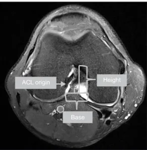 Table 1. Notch Morphometry Differences in ACL-Injured and Non- Non-Injured Subjects