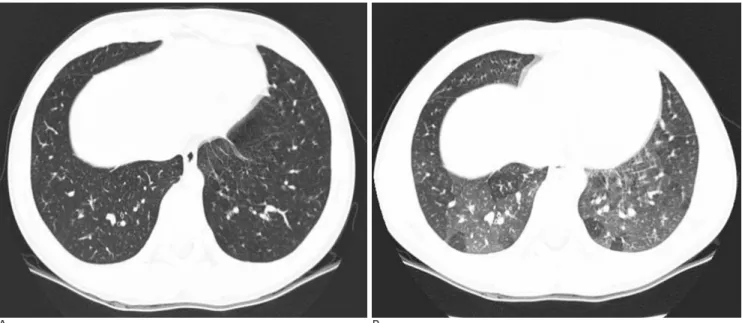 Fig. 2. Patient 1. A 13-year-old male presented with cough and sputum. On full inspiratory phase HRCT scan (A), there is a mass- mass-like consolidation (arrow) in left lower lobe posterior basal segment