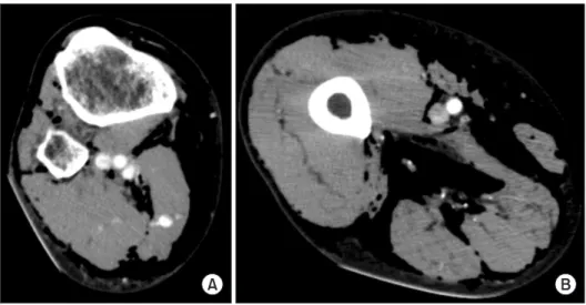 Figure 4. Axial contrast-enhanced com- com-puted  tomography  scan  shows  a  large  amount of air within muscle bellies and  interfascial  planes  in  thigh  and  knee