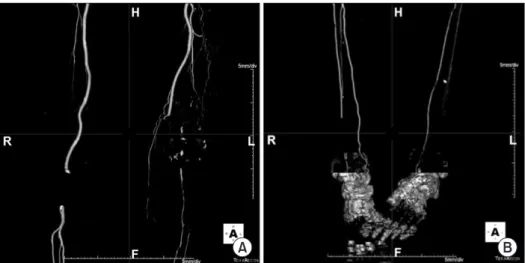 Figure 6. Three-domension computed tomo- tomo-graphy of the left lower extremity. (A) Stenosis  of the popliteal artery