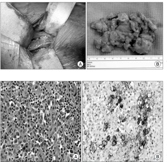 Figure 5. Pathologic findings. (A) Diffuse  infiltration  of  malignant  cells,  some  showing  Reed-Sternberg  like  features  (H&amp;E,  ×400)