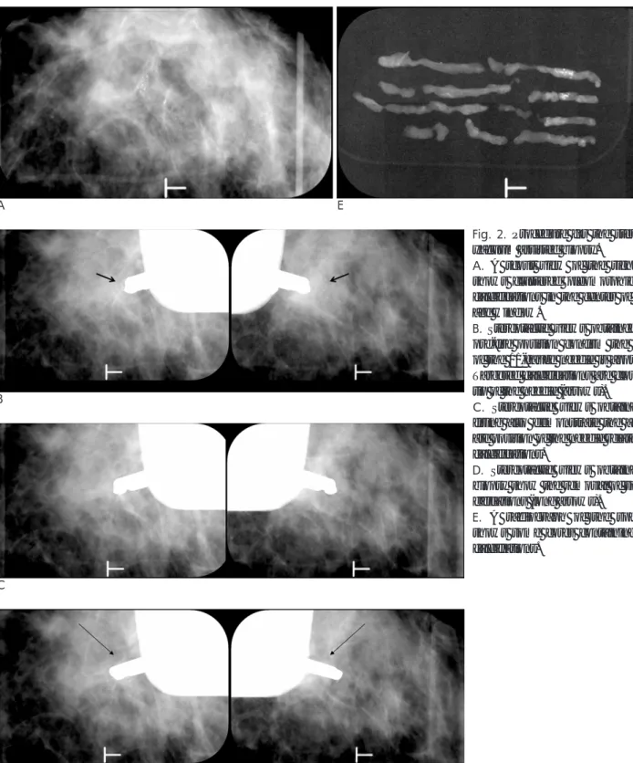 Fig. 2. Procedure for the stereotactic yacuum assisted biopsy.