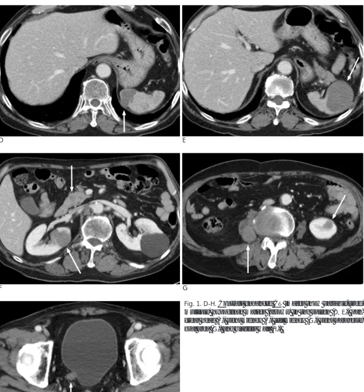 Fig. 1. D-H. Contrast enhanced CT images show variable-sized, multiple, hypodense masses (arrows) in the spleen (D, E),  pan-creas head (F), right kidney (F), left kidney (G), right  paraverte-bral area (G), and bladder wall (H)