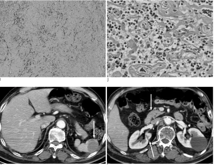 Fig. 1. I, J. Diffuse, dense collagenous fibrosis admixed with intervening, mature looking lymphoid cells and plasma cells, which are consistent with IMT histology (H &amp; E staining, I: ×40, J: ×400)