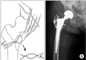 Figure 2. Anteriorposterior radiographs of  the hip. (A) A 83-year-old woman patient  had an unstable intertrochanteric fracture